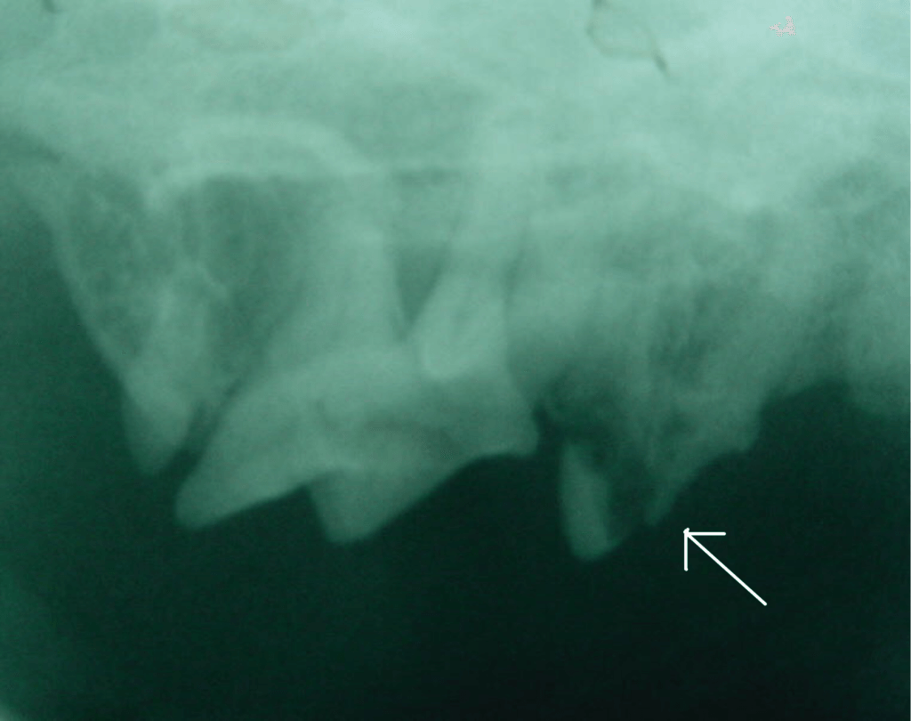 Tooth Resorption X-Ray Image
